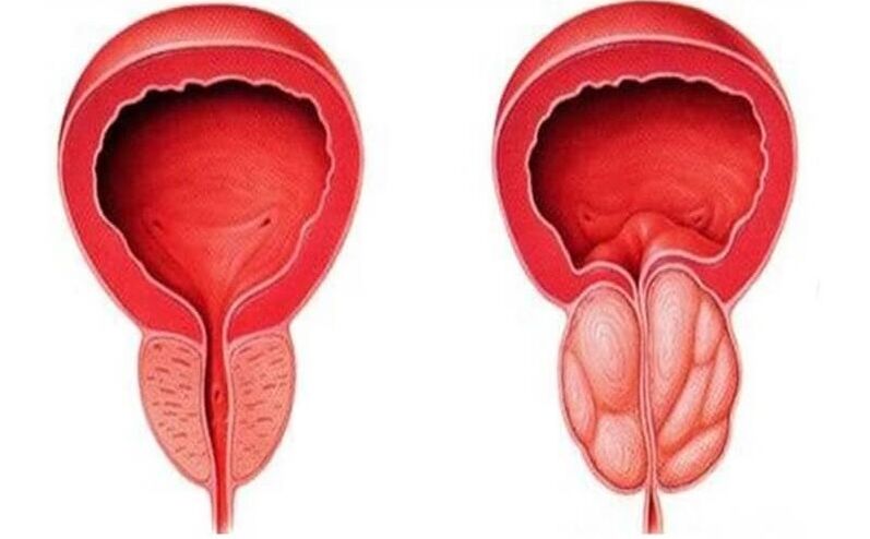 prostata sana e infiammata con prostatite