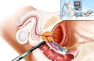 modi per diagnosticare la prostatite